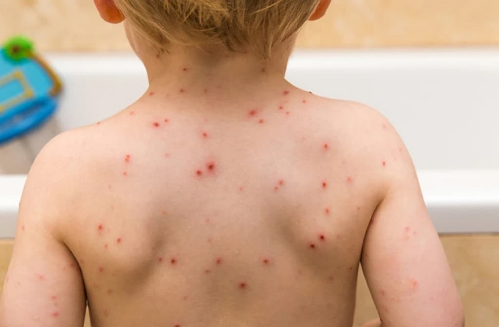 I u Kantonu Sarajevo proglašena epidemija morbila; Hasanović: Nećemo uvoditi nove mjere