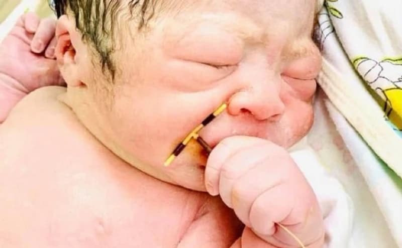 Žena ostala trudna uprkos kontracepciji: Beba rođena sa spiralom u ruci